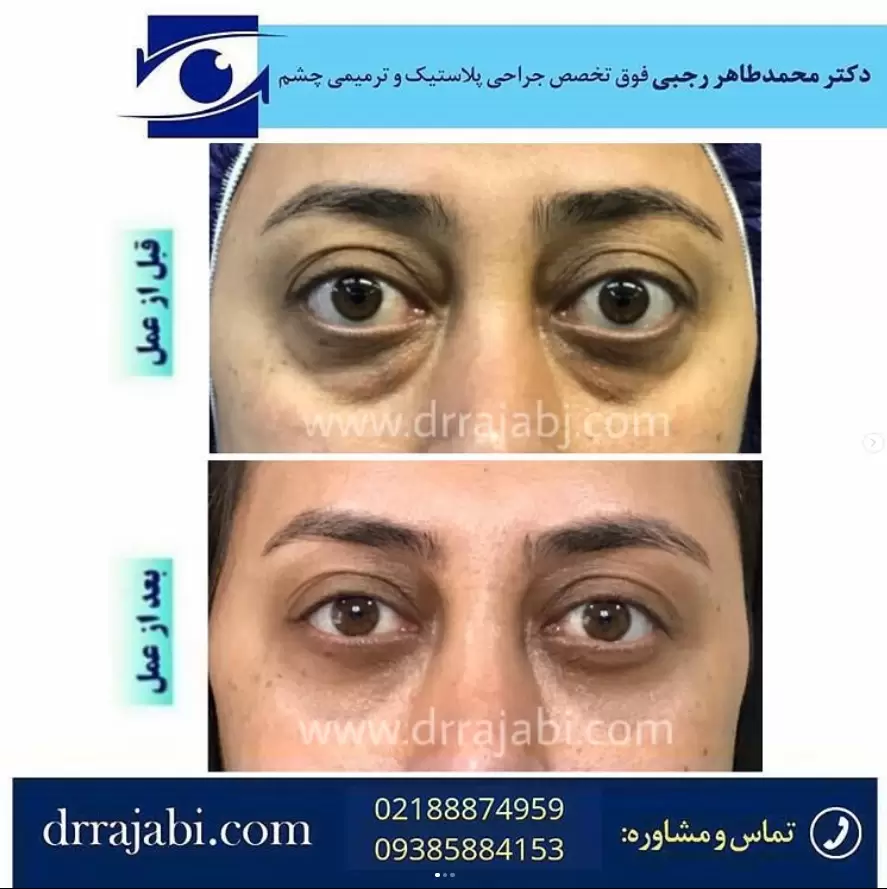 جراحی تیروئید چشمی
