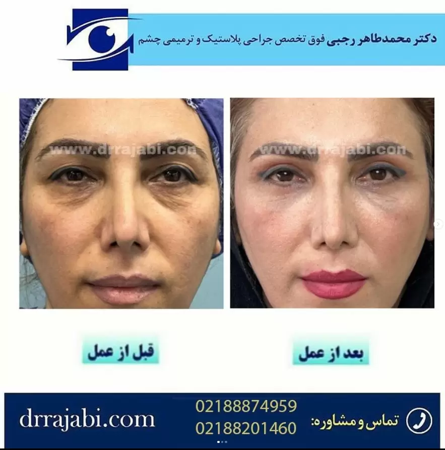 جراحی بلفاروپلاستی