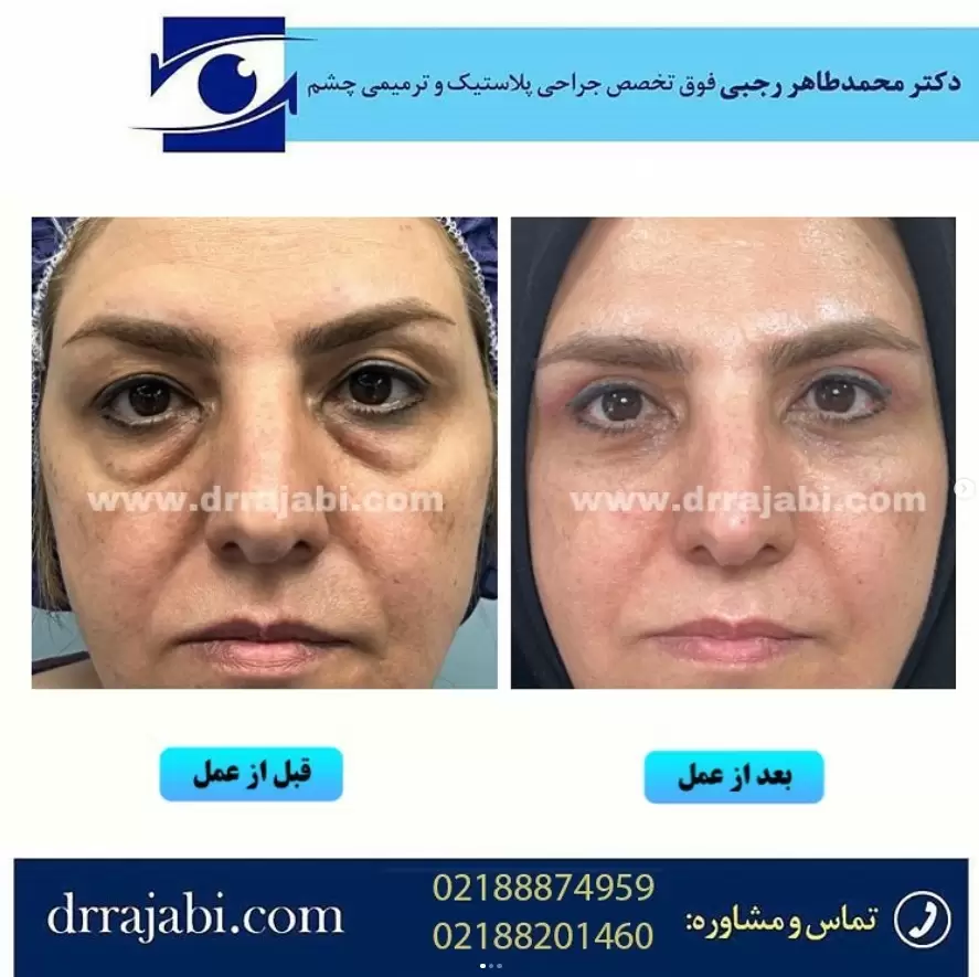 جراحی پف چشم
