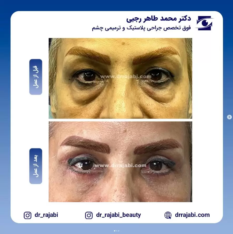 جراحی پف چشم