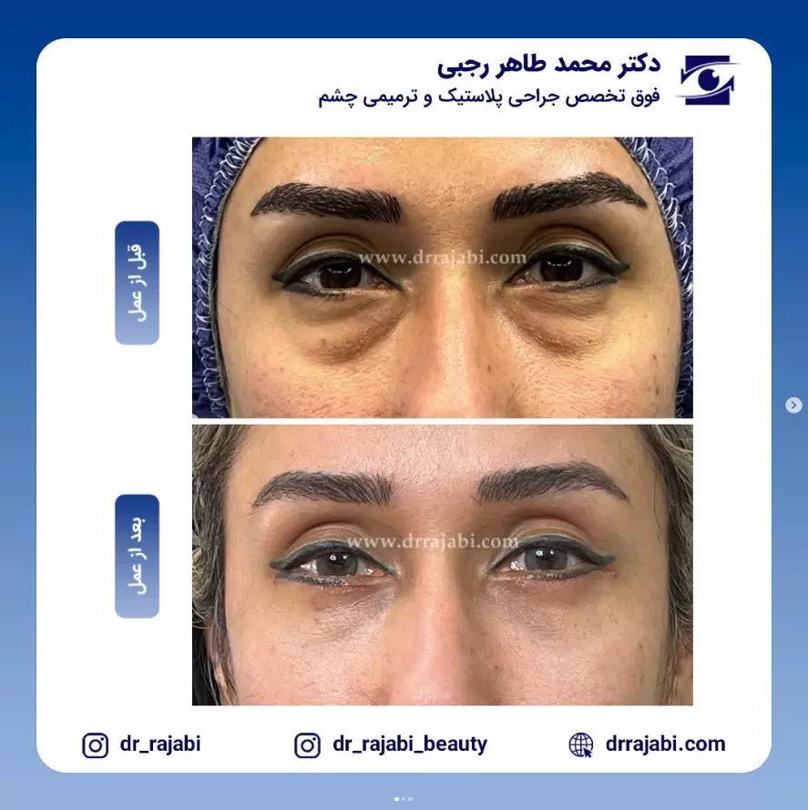 بلفاروپلاستی
