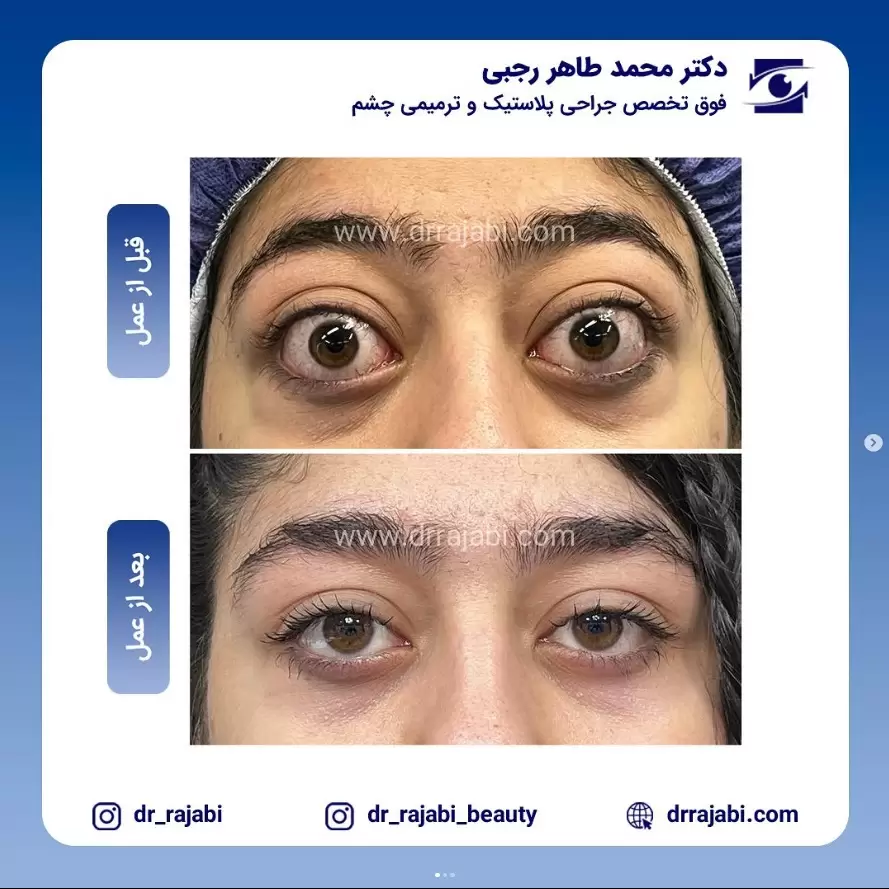 تیروئید چشمی