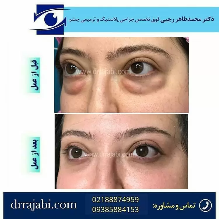 هزینه بلفاروپلاستی