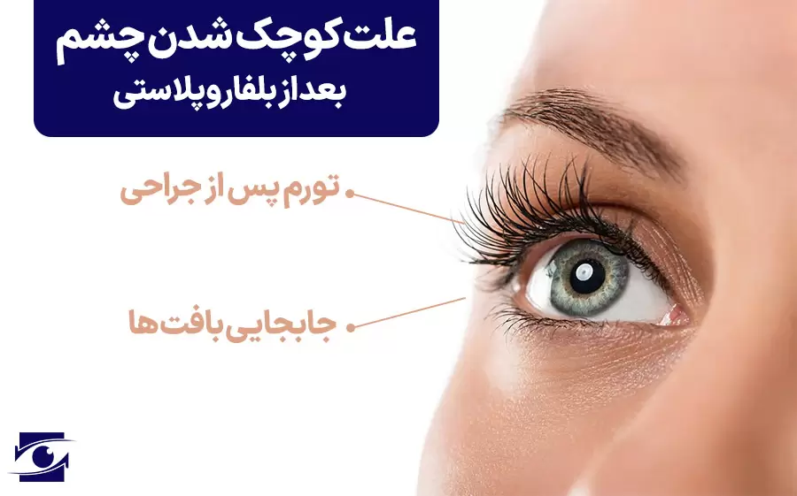 کوچک شدن چشم بعد از بلفاروپلاستی