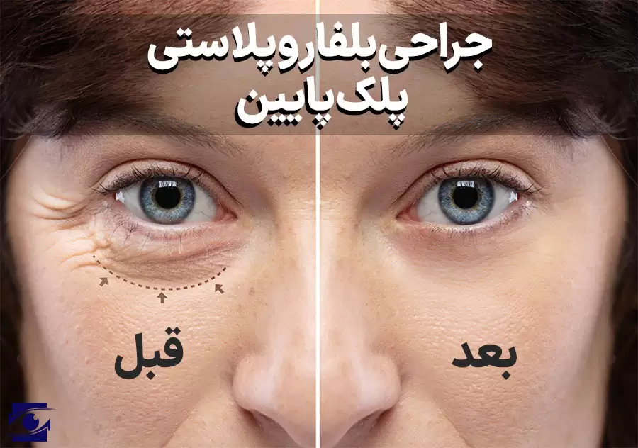 بلفاروپلاستی پلک پایین