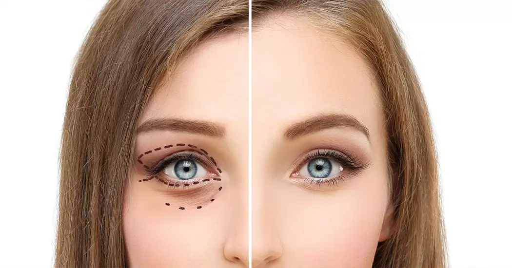 مراقبتهای بعد از عمل چشم گربهای