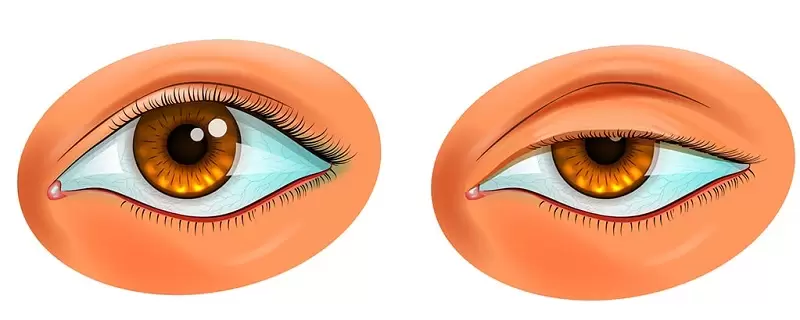 انواع پتوز چشم