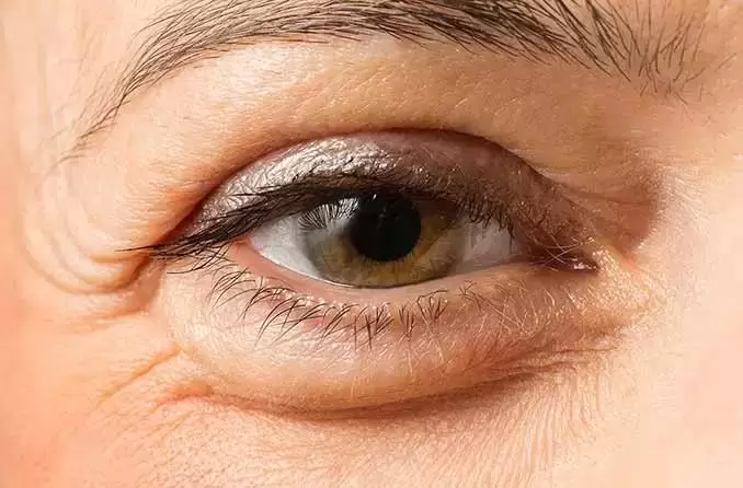 راهکارهای کاهش پف زیر جشم